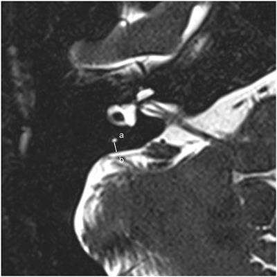 Non-contrast MRI of Inner Ear Detected Differences of Endolymphatic Drainage System Between Vestibular Migraine and Unilateral Ménière's Disease